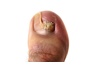 Treating Toenail Fungus With Creams and Devices