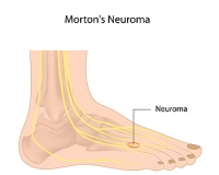How Morton’s Neuroma Affects the Foot